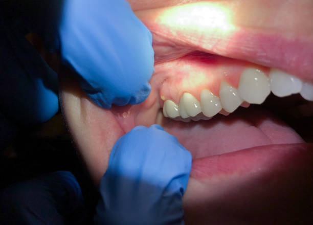 Best Emergency Root Canal Treatment in Jessup, MD